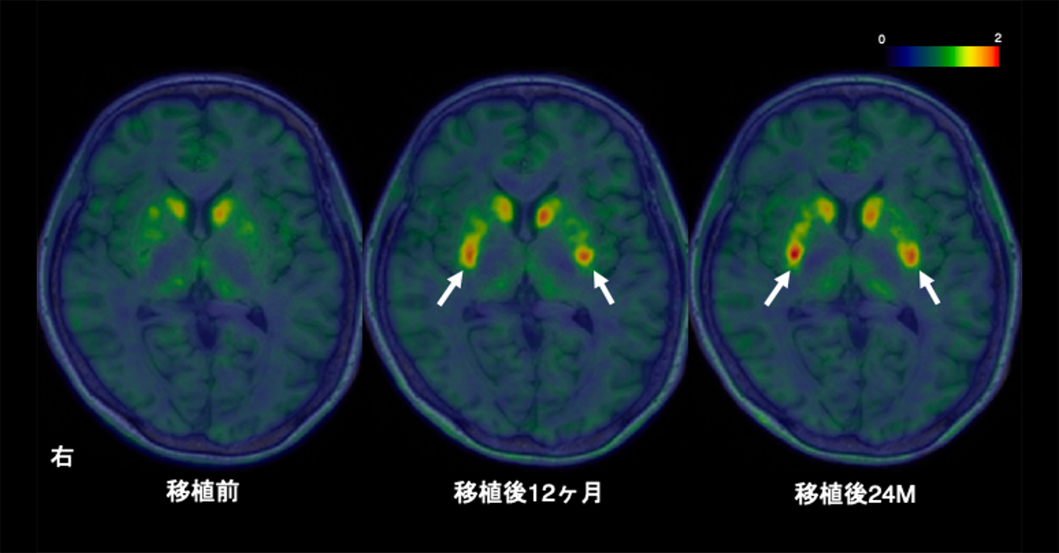 「iPS細胞由来ドパミン神経前駆細胞を⽤いたパーキンソン病治療に関する医師主導治験」において安全性と有効性が⽰唆