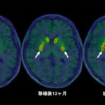 「iPS細胞由来ドパミン神経前駆細胞を⽤いたパーキンソン病治療に関する医師主導治験」において安全性と有効性が⽰唆