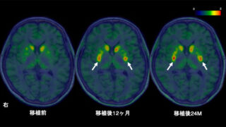 「iPS細胞由来ドパミン神経前駆細胞を⽤いたパーキンソン病治療に関する医師主導治験」において安全性と有効性が⽰唆