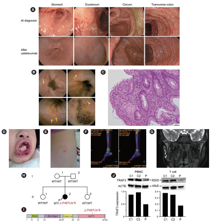 炎症性腸疾患(IBD)の発症に関与する新たな遺伝子変異を初めて同定～生物学的製剤による治療に成功した小児症例の報告～