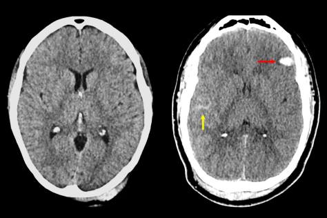 脳損傷の深刻度評価に新基準(How Serious is Your Brain Injury? New Criteria Will Reveal More)