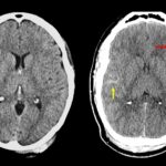 脳損傷の深刻度評価に新基準(How Serious is Your Brain Injury? New Criteria Will Reveal More)