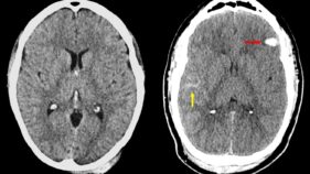 脳損傷の深刻度評価に新基準(How Serious is Your Brain Injury? New Criteria Will Reveal More)
