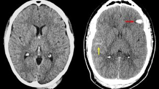 脳損傷の深刻度評価に新基準(How Serious is Your Brain Injury? New Criteria Will Reveal More)