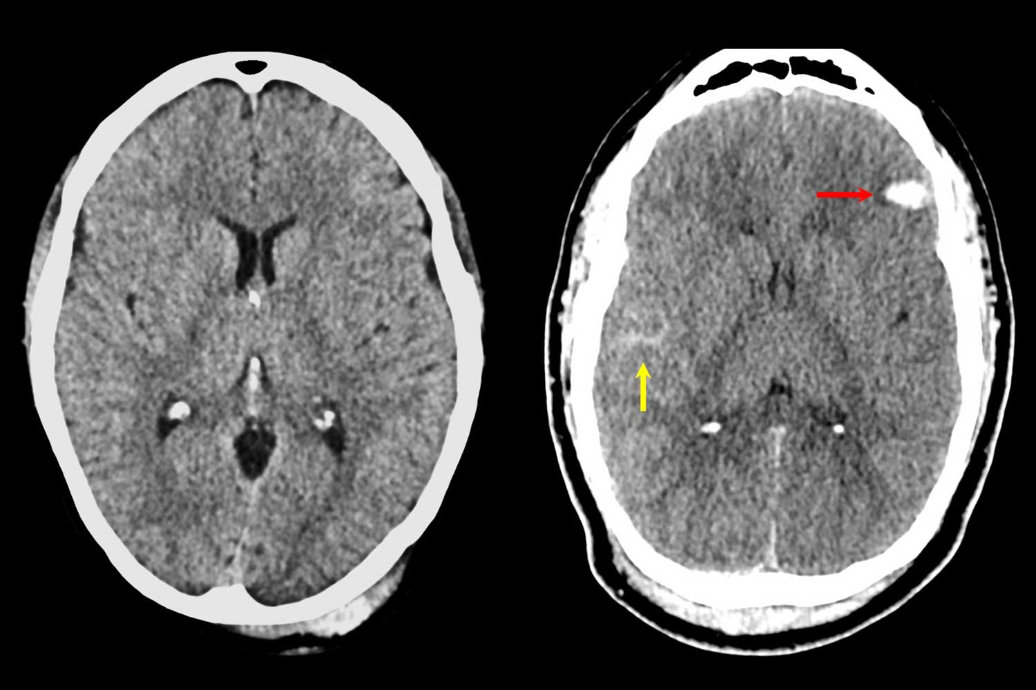 脳損傷の深刻度評価に新基準(How Serious is Your Brain Injury? New Criteria Will Reveal More)