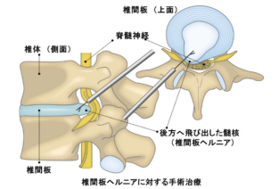 腰椎椎間板ヘルニア⼿術患者を対象としたバイオマテリアル使⽤による臨床試験で椎間板摘出術後の組織再⽣効果を確認～Nature Communications 誌に発表～