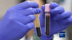 アルツハイマー病の診断を変える可能性のある血液検査(Alzheimer’s blood test could be a ‘game-changer’)