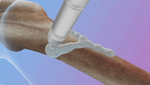 世界初の「骨用接着剤」を開発(ZJU develops world’s first bone glue)