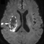 脳出血患者予後の影響、社会復帰を妨げるのは“隠れ脳梗塞”だった～国際研究で病態把握におおきく前進～