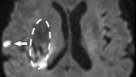 脳出血患者予後の影響、社会復帰を妨げるのは“隠れ脳梗塞”だった～国際研究で病態把握におおきく前進～
