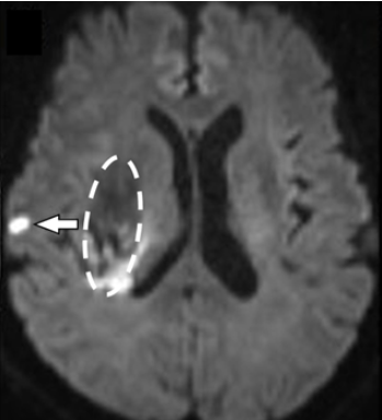 脳出血患者予後の影響、社会復帰を妨げるのは“隠れ脳梗塞”だった～国際研究で病態把握におおきく前進～