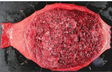 GAPPSにおける胃癌発生に関わる遺伝子変異の解明