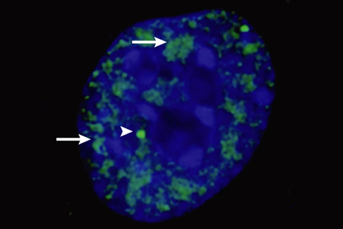 分子集合体「マイクロフェーズ」が神経変性疾患治療の新ターゲットに(Microphases are targets for therapeutic intervention for neurodegenerative disorders)