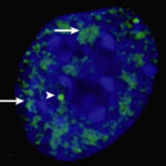 分子集合体「マイクロフェーズ」が神経変性疾患治療の新ターゲットに(Microphases are targets for therapeutic intervention for neurodegenerative disorders)