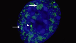 分子集合体「マイクロフェーズ」が神経変性疾患治療の新ターゲットに(Microphases are targets for therapeutic intervention for neurodegenerative disorders)
