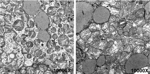 レーザー技術でメラノーマを高精度検出 (A laser focus on melanoma)