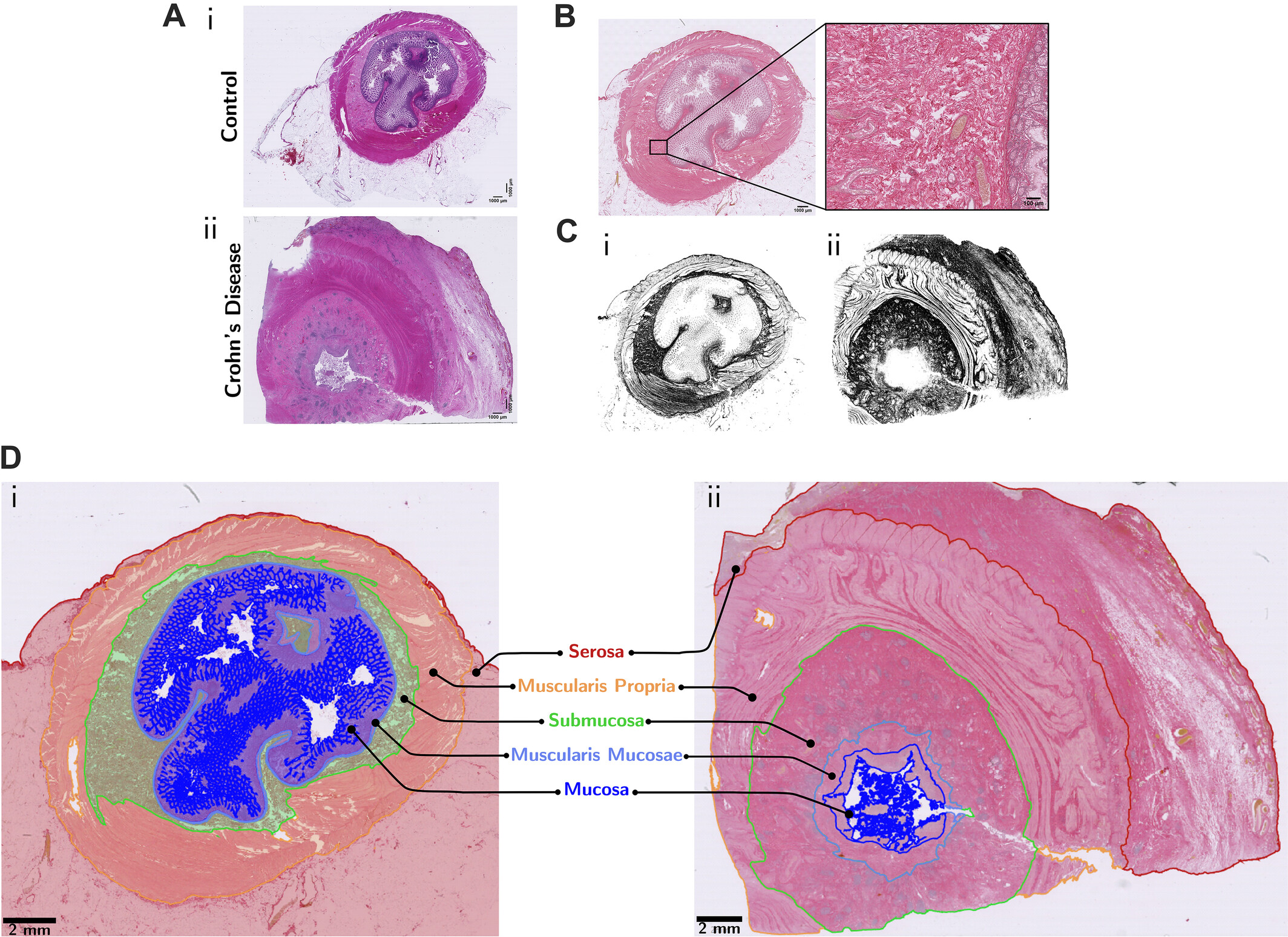 クローン病における腸の瘢痕形成の原因を特定（Crohn&rsquo;s disease bowel scarring trigger identified）