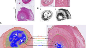 クローン病における腸の瘢痕形成の原因を特定（Crohn&rsquo;s disease bowel scarring trigger identified）