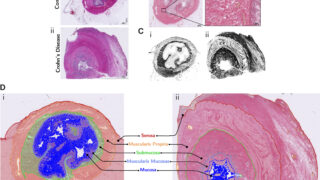 クローン病における腸の瘢痕形成の原因を特定（Crohn&rsquo;s disease bowel scarring trigger identified）