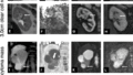 MRIによる腎疾患の超早期予測の可能性を示す研究 (Could MRI Predict Kidney Disease Before It Develops? Award-Winning Study Suggests New Possibilities)