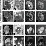 MRIによる腎疾患の超早期予測の可能性を示す研究 (Could MRI Predict Kidney Disease Before It Develops? Award-Winning Study Suggests New Possibilities)