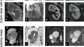 MRIによる腎疾患の超早期予測の可能性を示す研究 (Could MRI Predict Kidney Disease Before It Develops? Award-Winning Study Suggests New Possibilities)