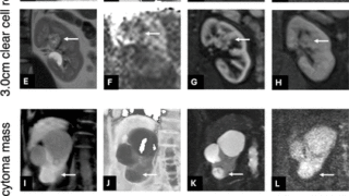 MRIによる腎疾患の超早期予測の可能性を示す研究 (Could MRI Predict Kidney Disease Before It Develops? Award-Winning Study Suggests New Possibilities)