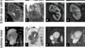 MRIによる腎疾患の超早期予測の可能性を示す研究 (Could MRI Predict Kidney Disease Before It Develops? Award-Winning Study Suggests New Possibilities)