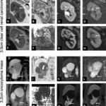 MRIによる腎疾患の超早期予測の可能性を示す研究 (Could MRI Predict Kidney Disease Before It Develops? Award-Winning Study Suggests New Possibilities)