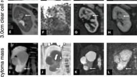 MRIによる腎疾患の超早期予測の可能性を示す研究 (Could MRI Predict Kidney Disease Before It Develops? Award-Winning Study Suggests New Possibilities)