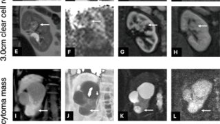 MRIによる腎疾患の超早期予測の可能性を示す研究 (Could MRI Predict Kidney Disease Before It Develops? Award-Winning Study Suggests New Possibilities)