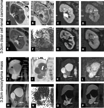 MRIによる腎疾患の超早期予測の可能性を示す研究 (Could MRI Predict Kidney Disease Before It Develops? Award-Winning Study Suggests New Possibilities)