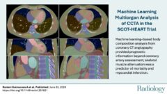 体幹筋力が心筋梗塞リスク低下と関連（Strong torso muscles linked to lower heart attack risk）