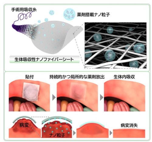 細胞外小胞などの治療用ナノ粒子を患部で少しずつ放出する 生体吸収性ナノファイバーシートの開発 ～次世代ドラッグデリバリーシステムによる新規治療法の実用化に期待～