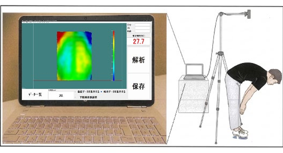 AI“頭脳”と3Dの“目”で服を着たままの側弯症検診が可能に 「SCOLIOMAP脊柱側弯モニタ」の開発・社会実装を実現